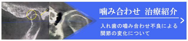 入れ歯　治療紹介