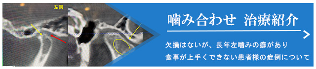 嚙み合わせ　治療紹介