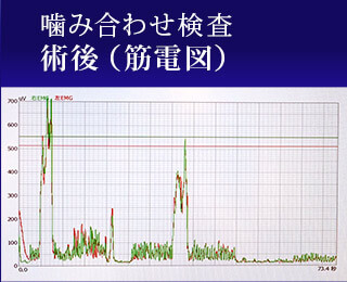 術後（筋電図）
