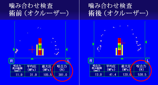 噛み合わせ検査